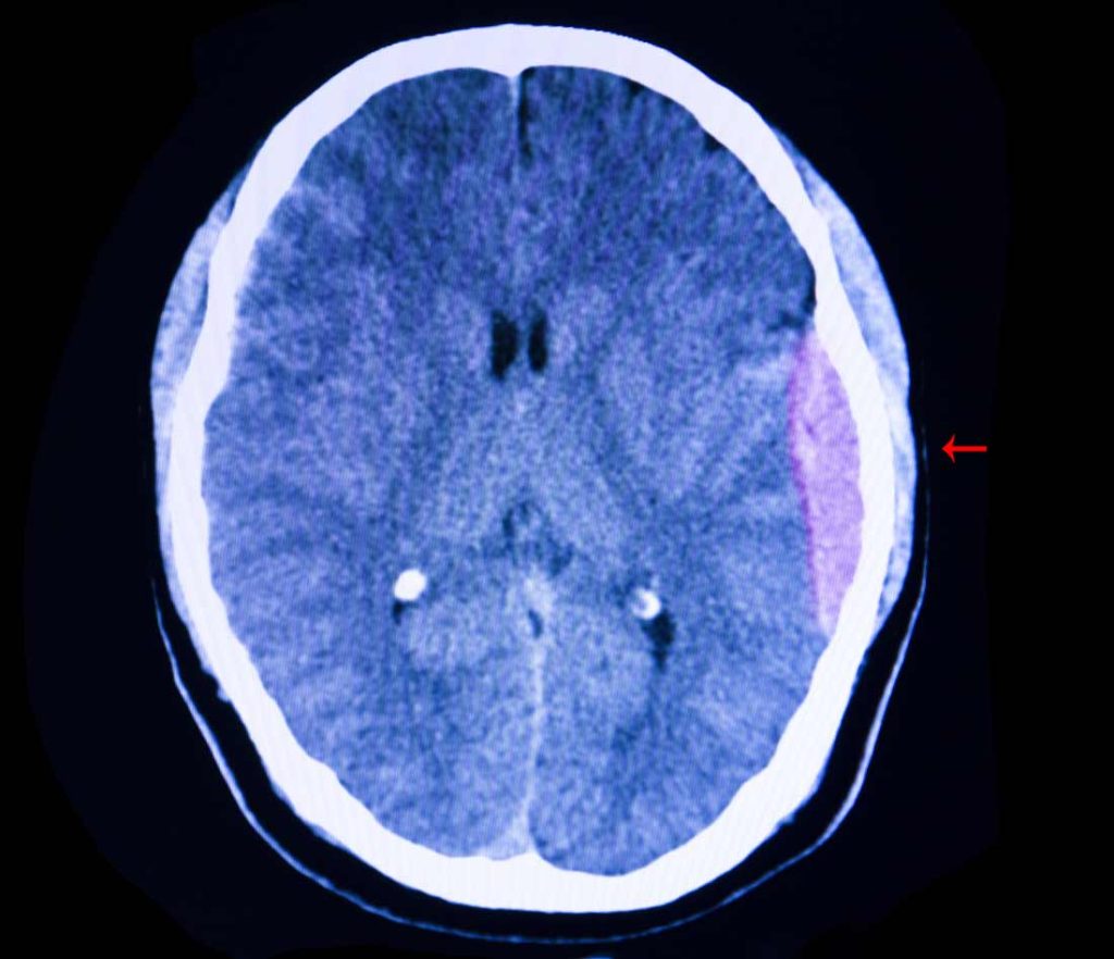 Epidural Vs Subdural Hematoma Epidural Vs Subdural Me Vrogue Co