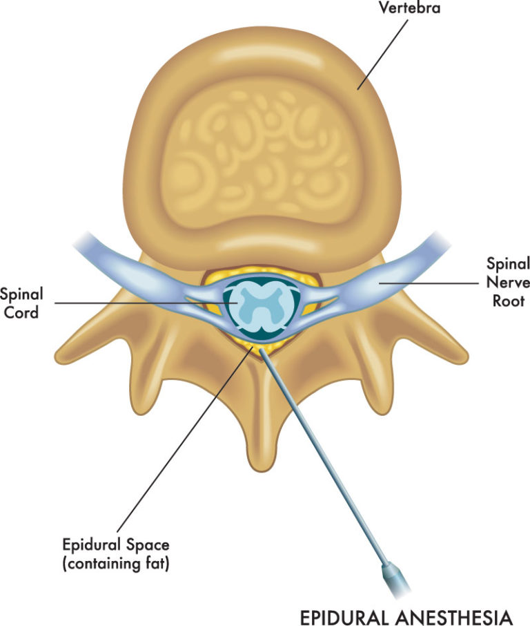 Ask Dr John Esq. - What Are Epidural Steroid Injections? - Diller Law ...