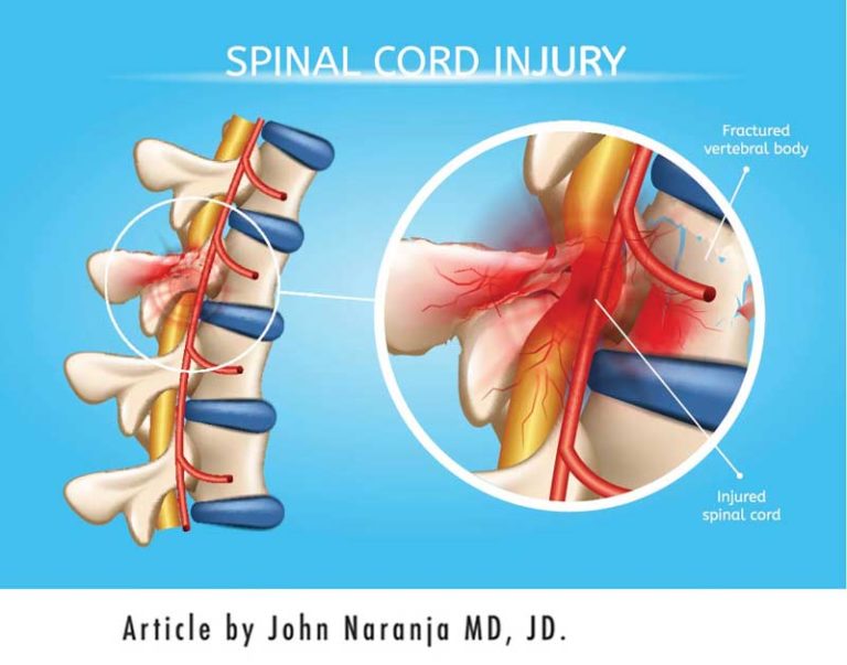 ask-dr-john-esq-spinal-cord-injury-and-types-of-paralysis-diller